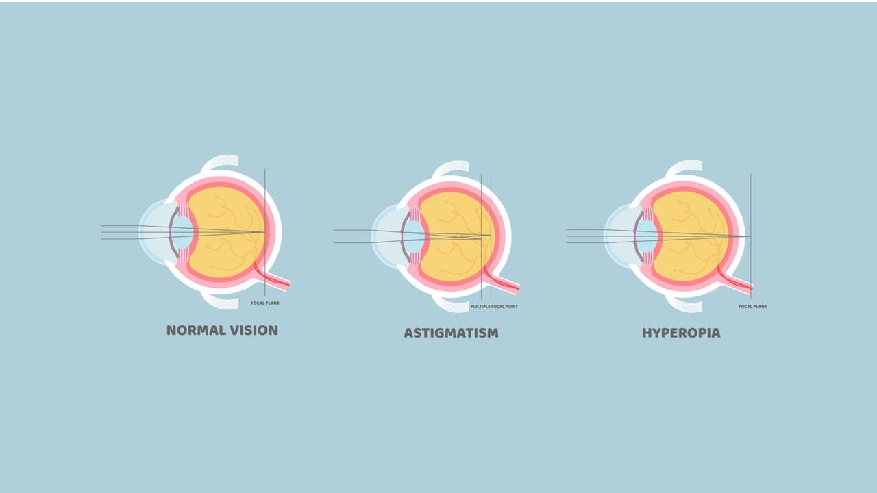 Astigmatismo e Ipermetropia: somiglianze e differenze