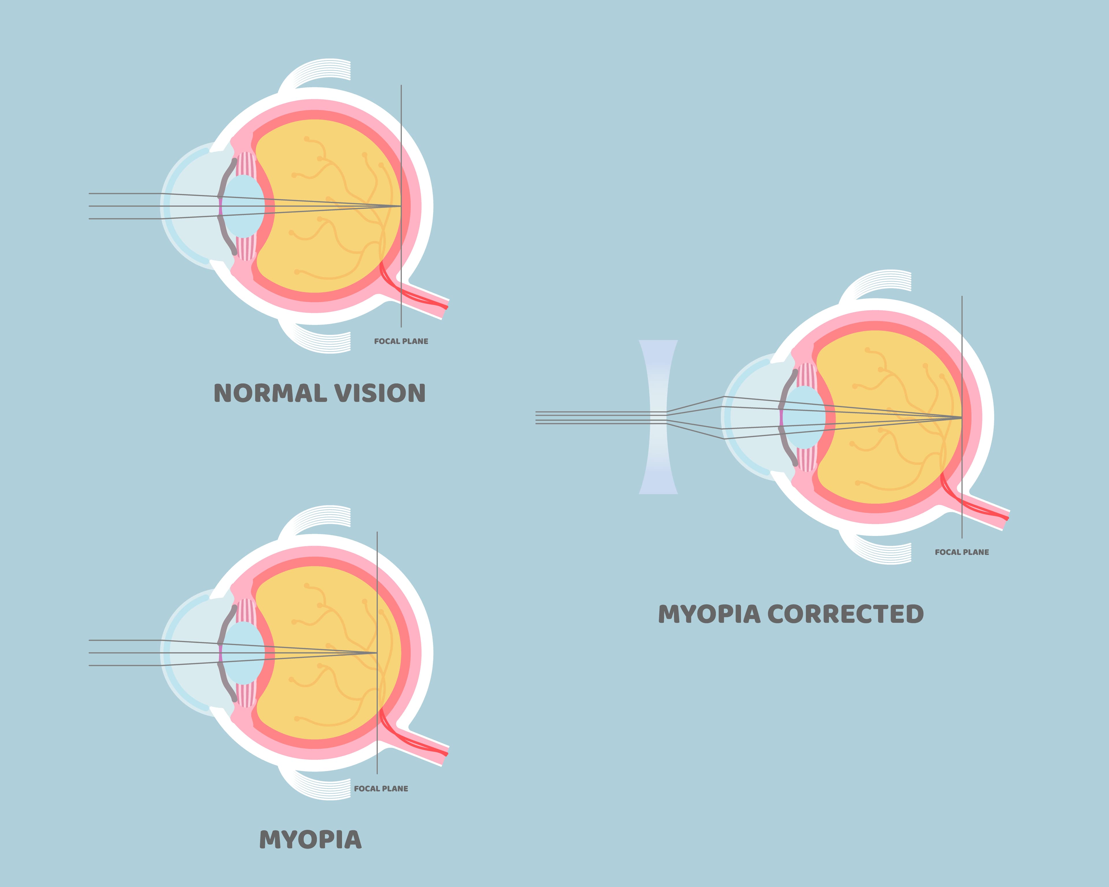 Miopia: cos’è, sintomi e operazione laser