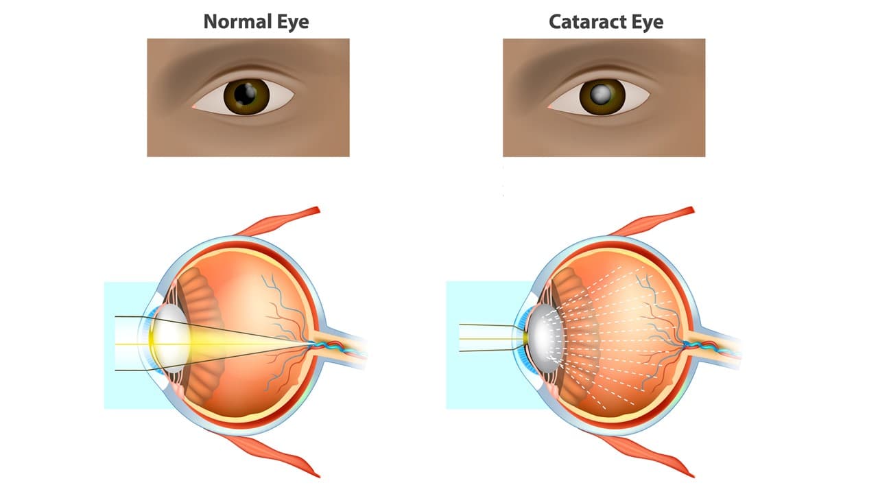 Cataratta: cos’è, sintomi e quando operare